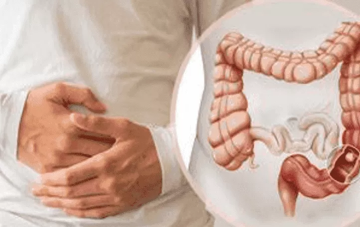 Understanding the Rise of Colon Cancer in Young Adults
